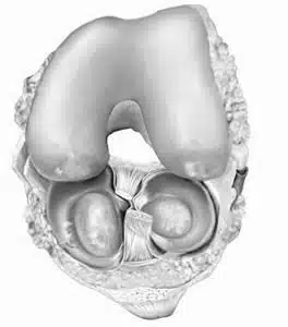 Advanced arthritic changes of the knee