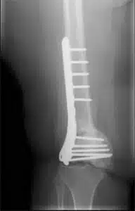 Post-traumatic arthritis